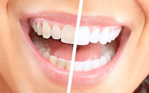 Bělení zubů Brno - zubní klinika Ascendent